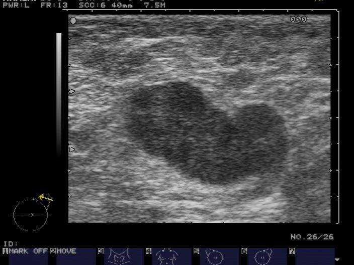 智能医疗新篇：乳腺超声AI病例库，如何从零散报告到精准决策？