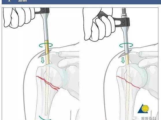 骨科间歇充气压缩技术到底是啥？俺给你唠明白！