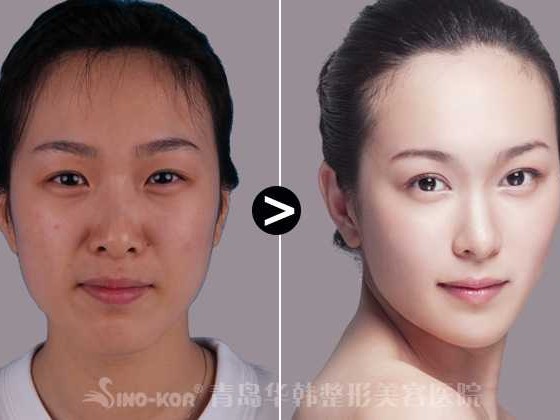 开眼角这事儿，真不是一刀切的技术活